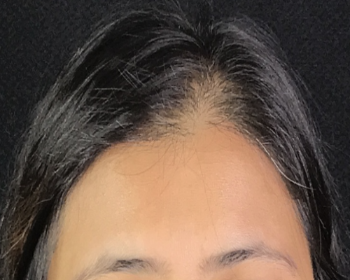Before Image: Hair Restoration - front